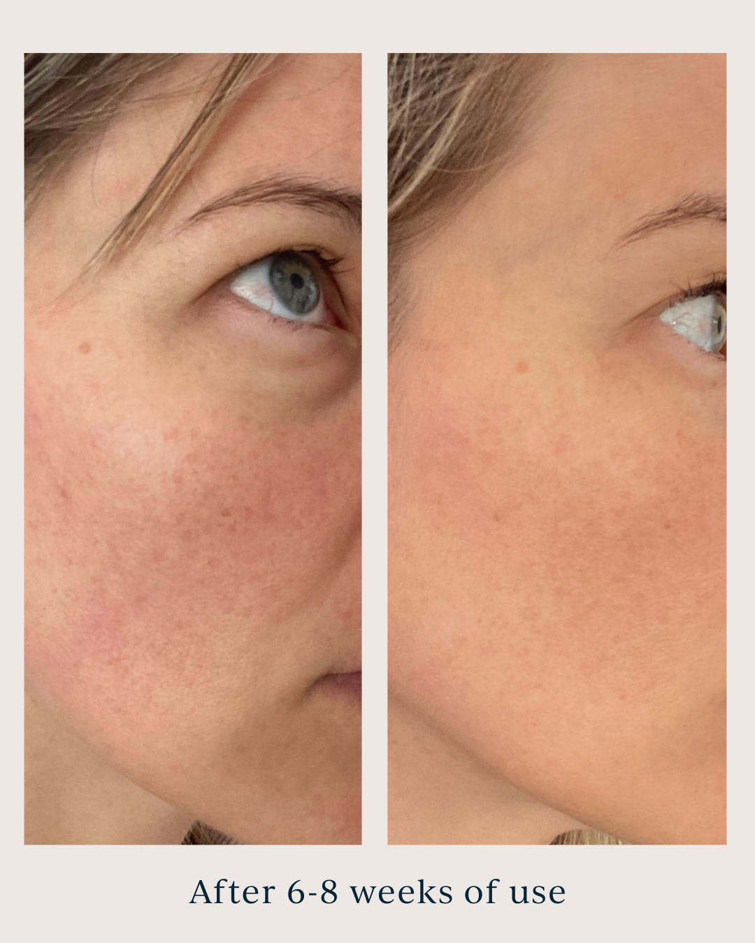 dark spots before and after using saya brightening peel