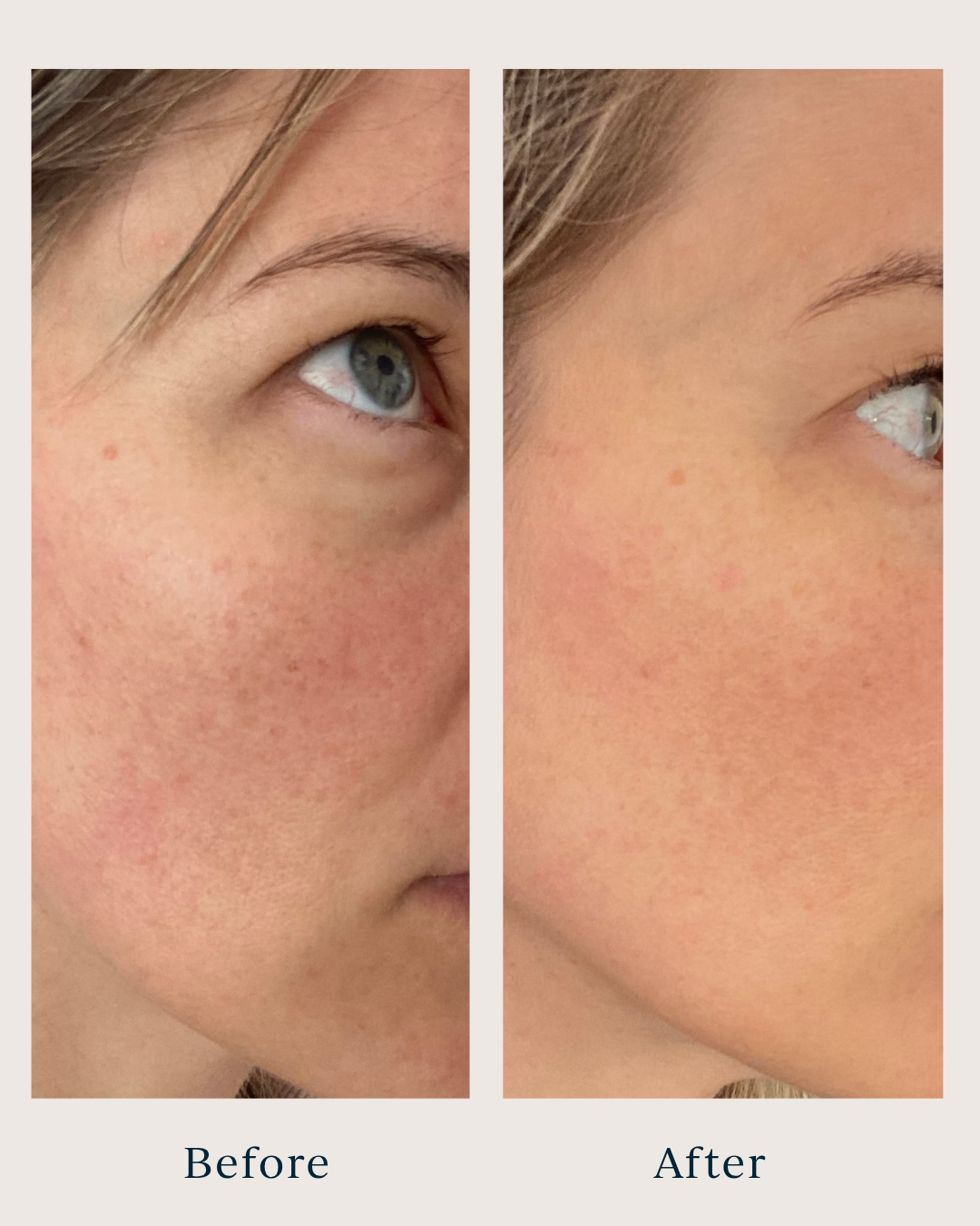 before and after pictures of a woman after using brightening peel