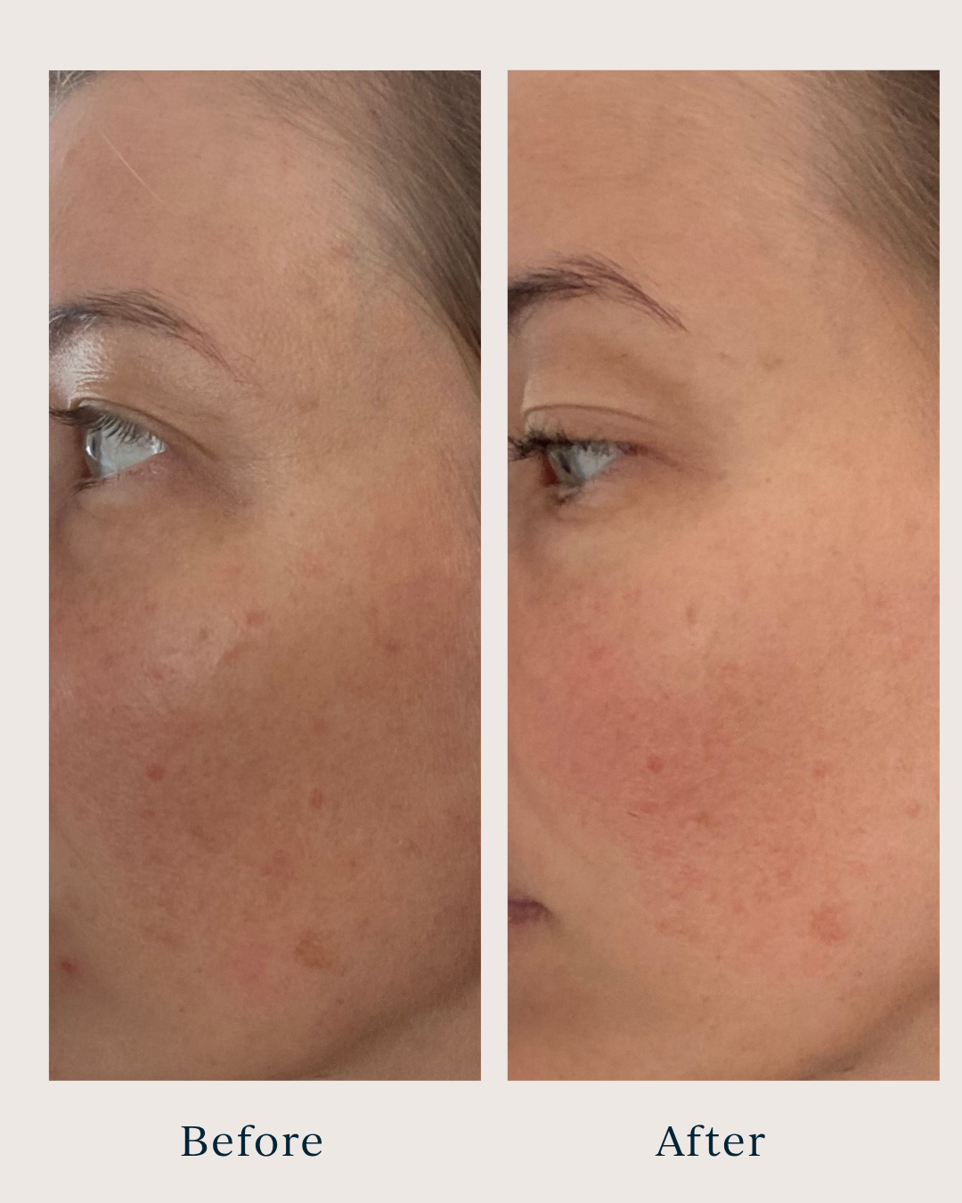 before and after pictures of a woman after using brightening peel