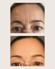 before and after pictures of a woman using renew serum