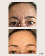 skin texture before and after using saya renew serum
