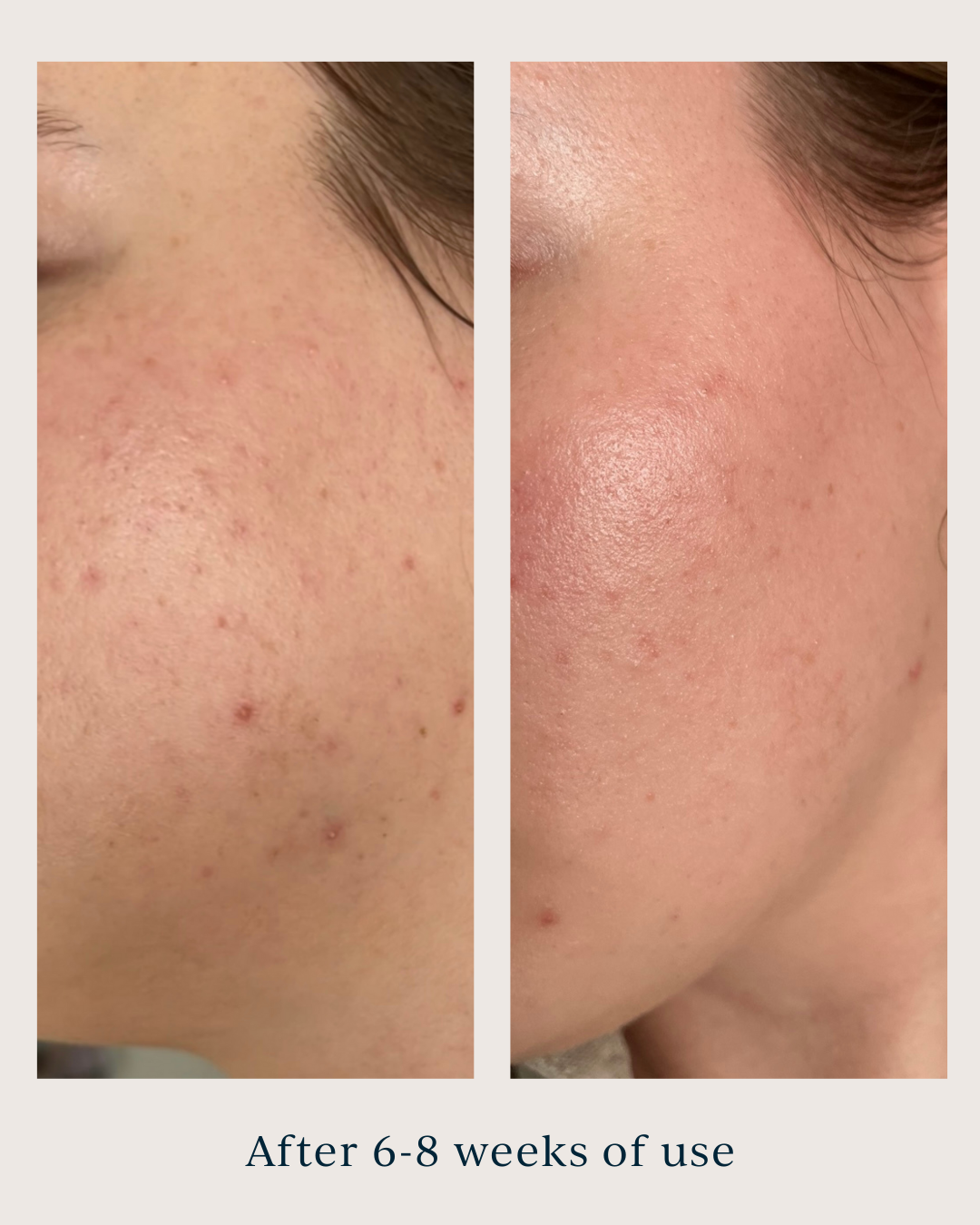 skin texture before and after using saya super serum