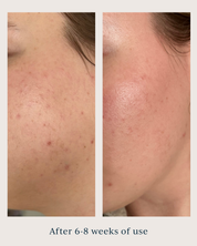 skin texture before and after using saya super serum