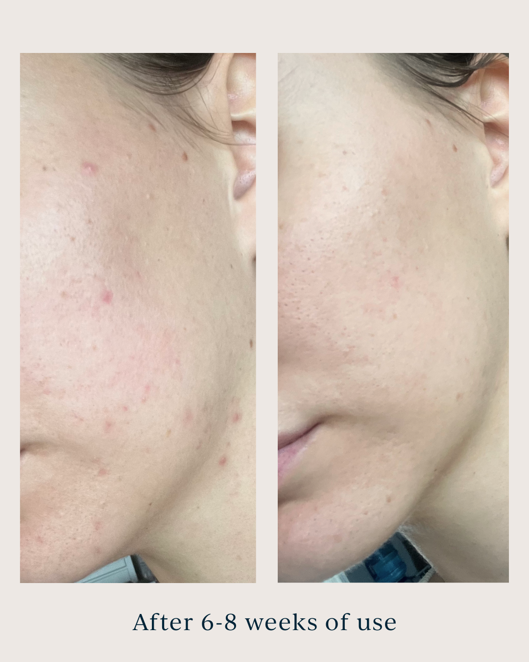 skin texture before and after using saya super serum