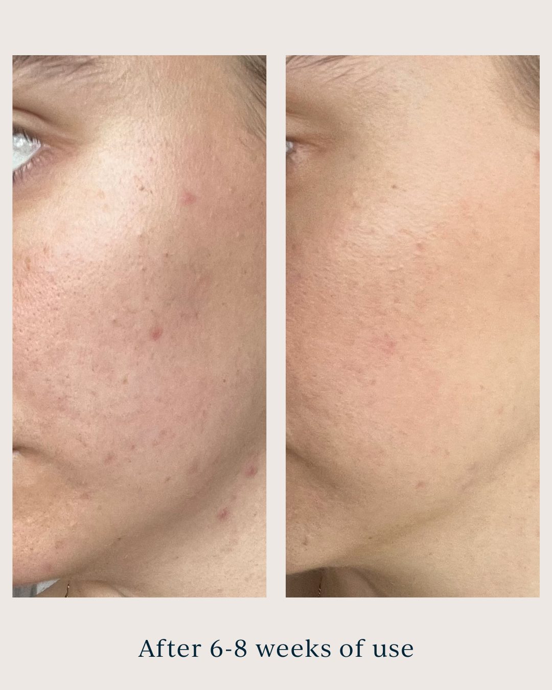 skin tone and texture after using saya super serum