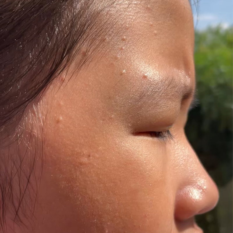 Pre-teen acne