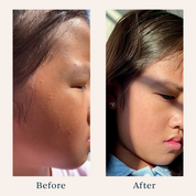 before and after photos of a girl's acne after using toofruit so cool face gel
