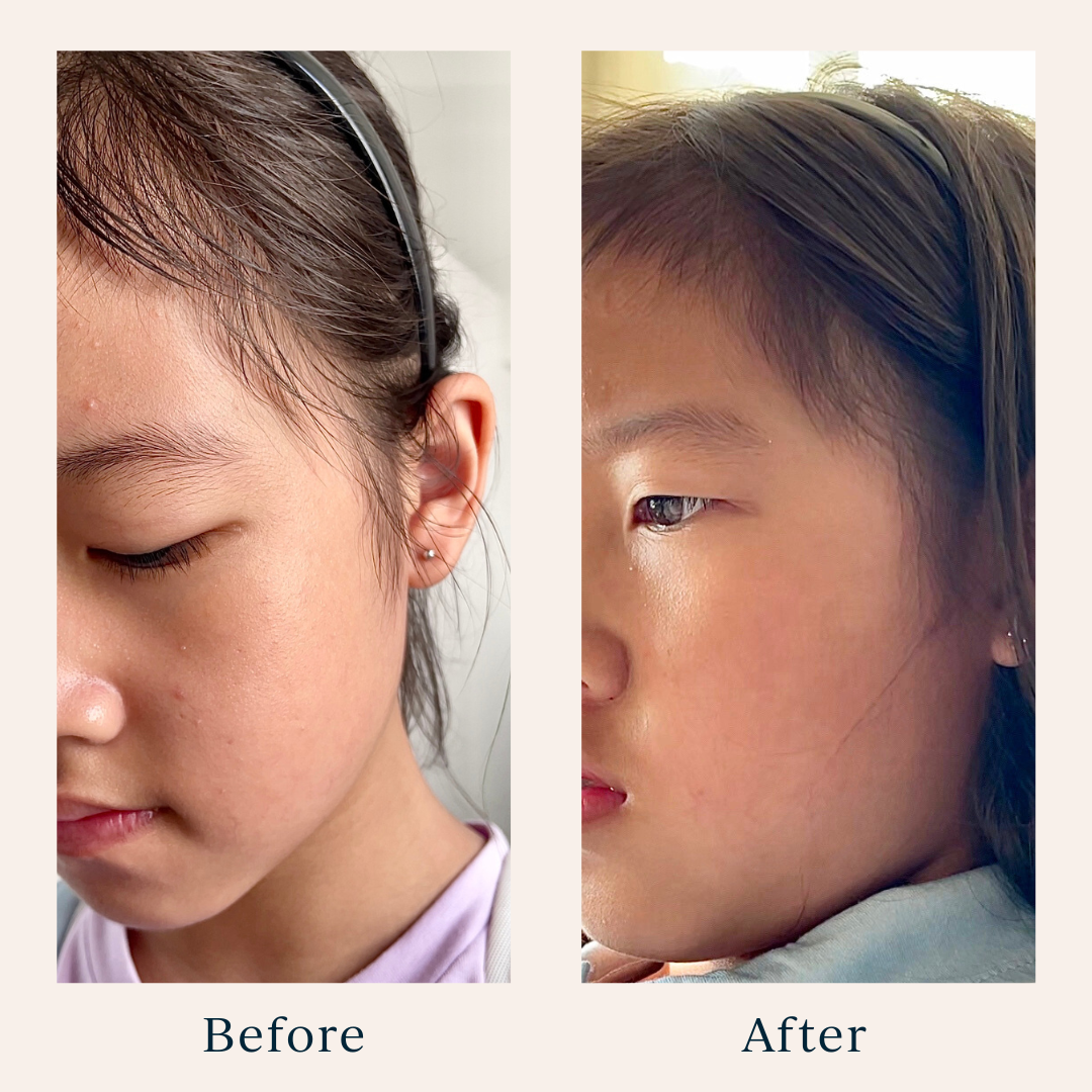 before and after photos of a girl's acne after using toofruit so cool face gel