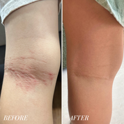 before and after photos of redness on back of knee