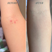 before and after photos of redness on arm 